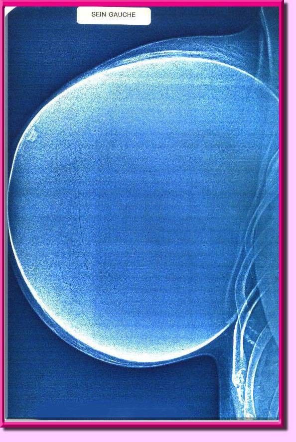 X-Ray of Lolo Ferrari’s 36 MMM Tits, 6.2 lbs apiece!