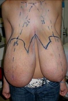 GIGANTIC MAMMARIES ABOUT TO GET SMALLER, WHAT A PITY