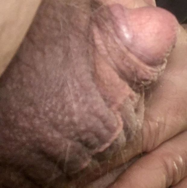 My tiny Micropenis